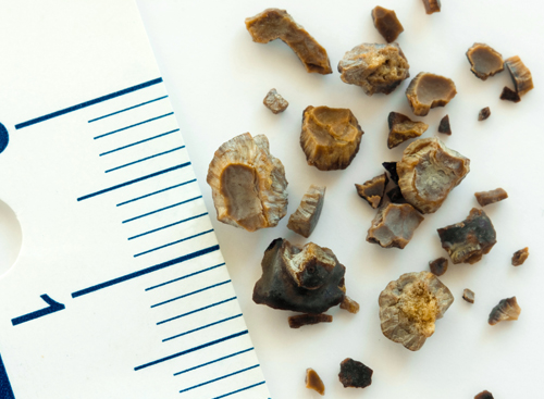 kidney-stones-sizes