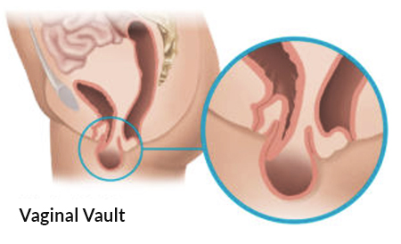 women-vaginal-vault-illustration