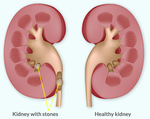 kidney-stones-illustration